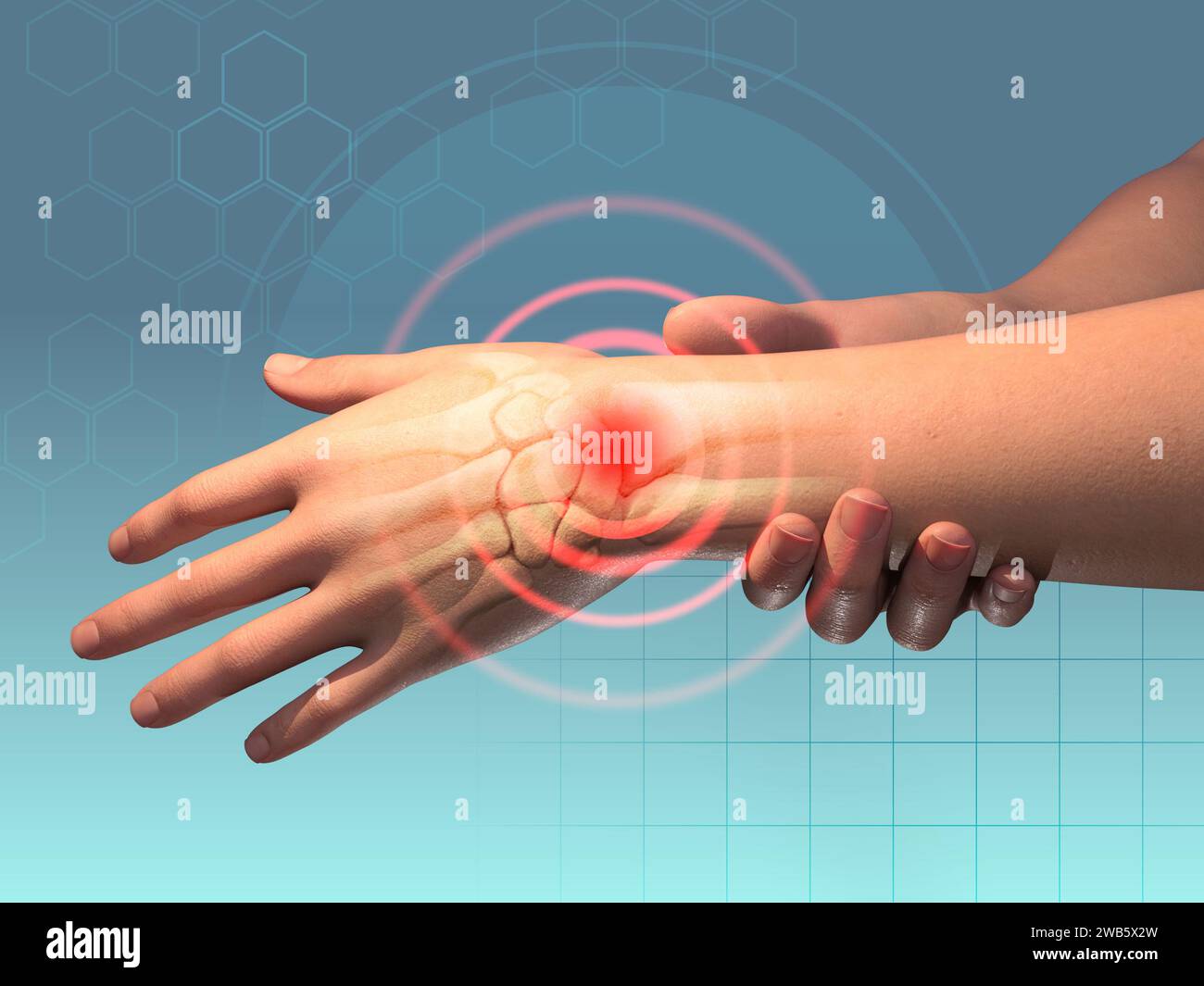 Handgelenkschmerzen, die durch Traumata oder andere gesundheitliche Probleme verursacht werden. Digitale Illustration, 3D-Rendering. Stockfoto