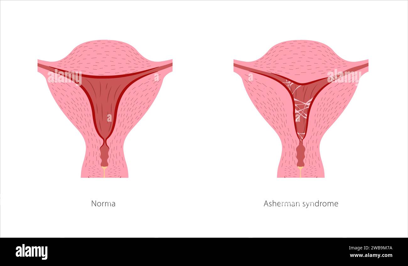 Das Asherman-Syndrom des weiblichen Fortpflanzungssystems. Uterusquerschnitt mit Aschesionen. Narbengewebe in Uterushöhle und gesundem Organ. Vektor i Stock Vektor