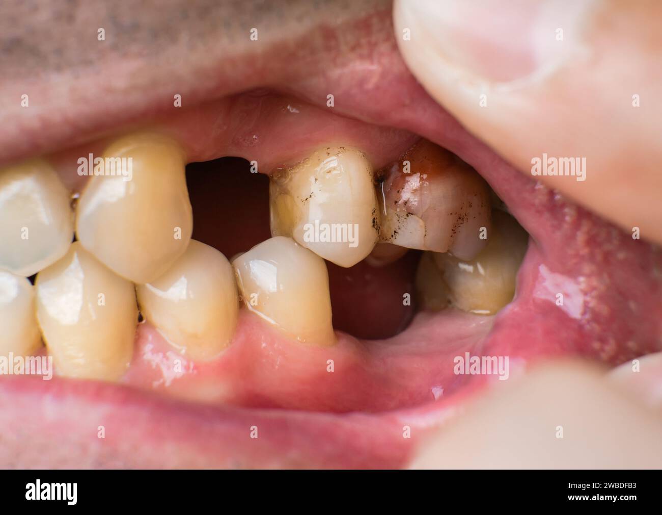 Fehlende Zähne und Zahnprobleme bei einem kaukasier Nahaufnahme Stockfoto