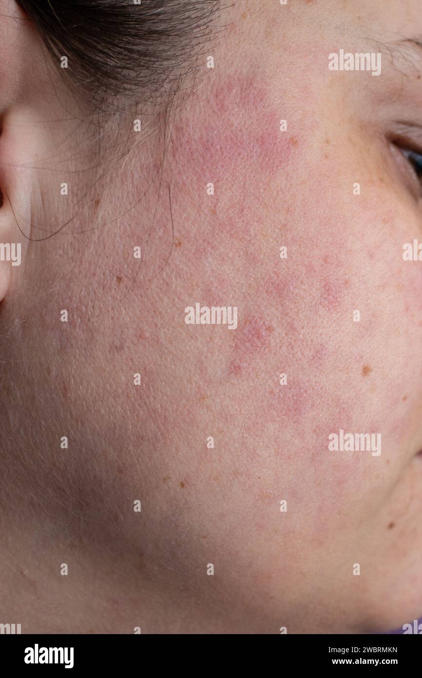 Hautausschlag im gesicht -Fotos und -Bildmaterial in hoher Auflösung – Alamy