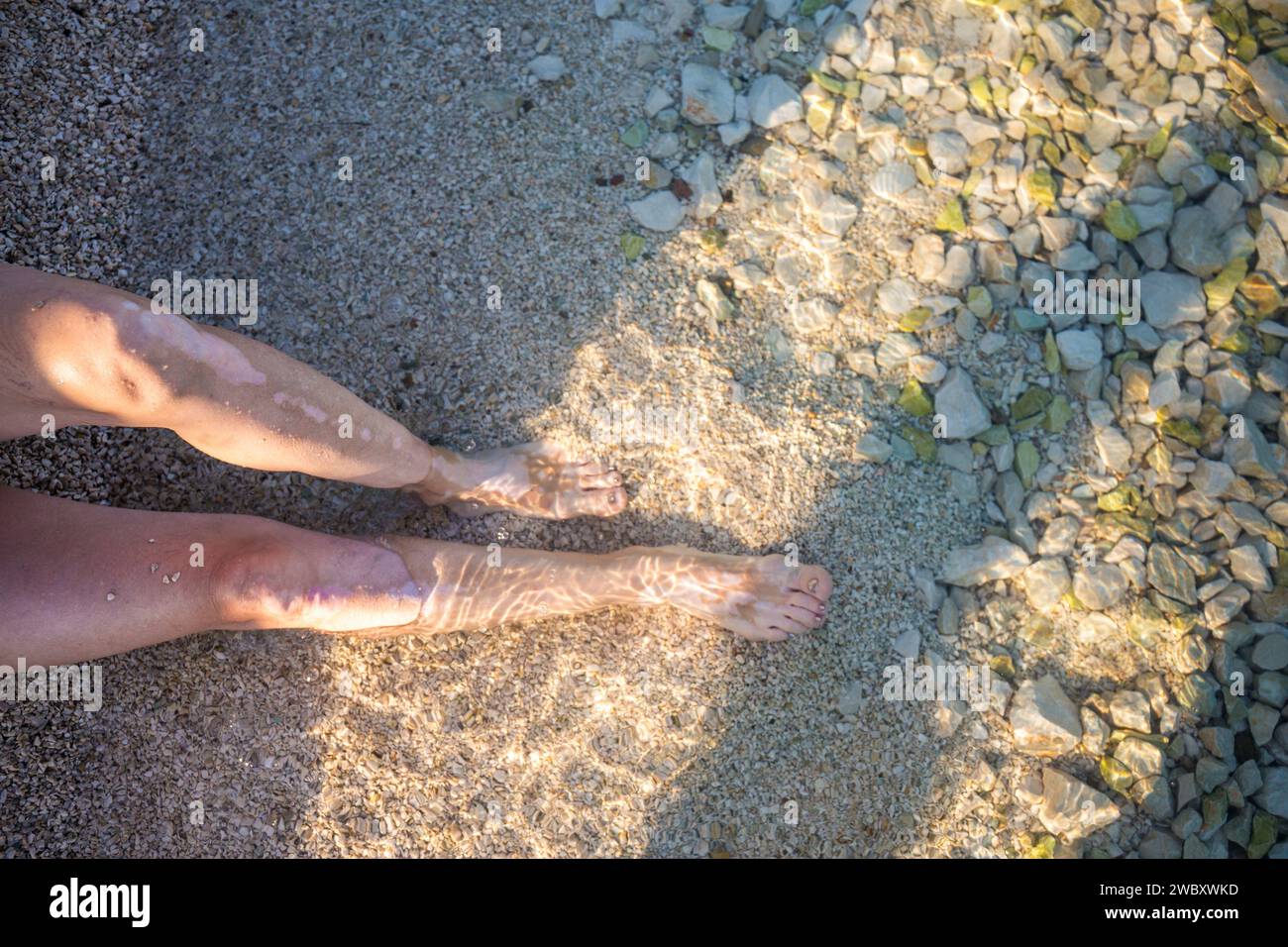 Frauenbeine mit Vitiligo-Pigmentierung Stockfoto