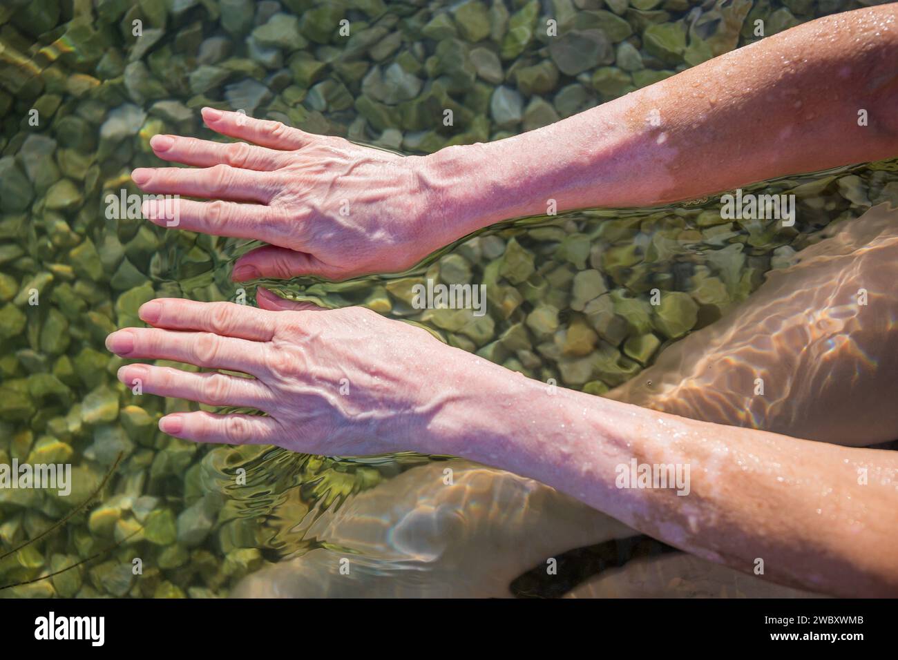 Frauenhände mit Vitiligo-Pigmentierung Stockfoto