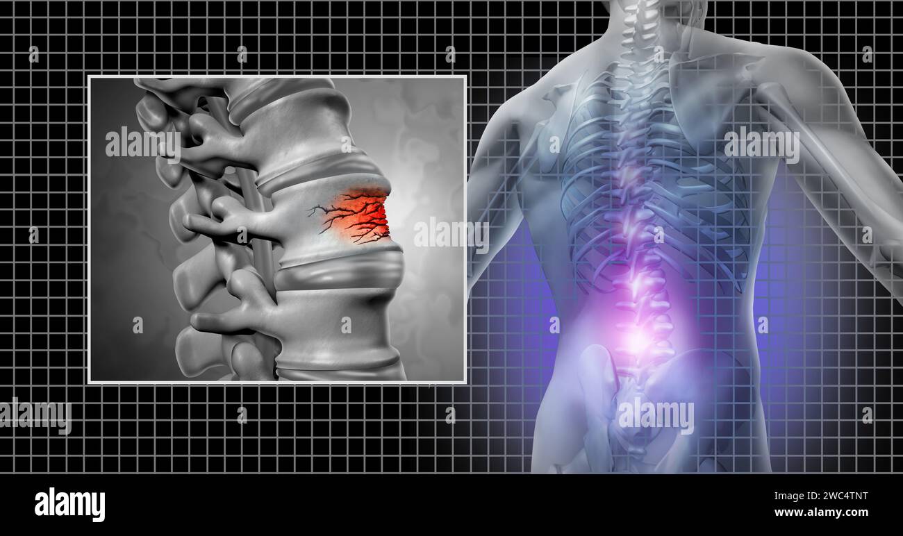 Wirbelsäulenfraktur und Unterrückenschmerzen als Wirbelsäulenverletzung und Wirbeltrauma als osteopathisches medizinisches Konzept. Stockfoto