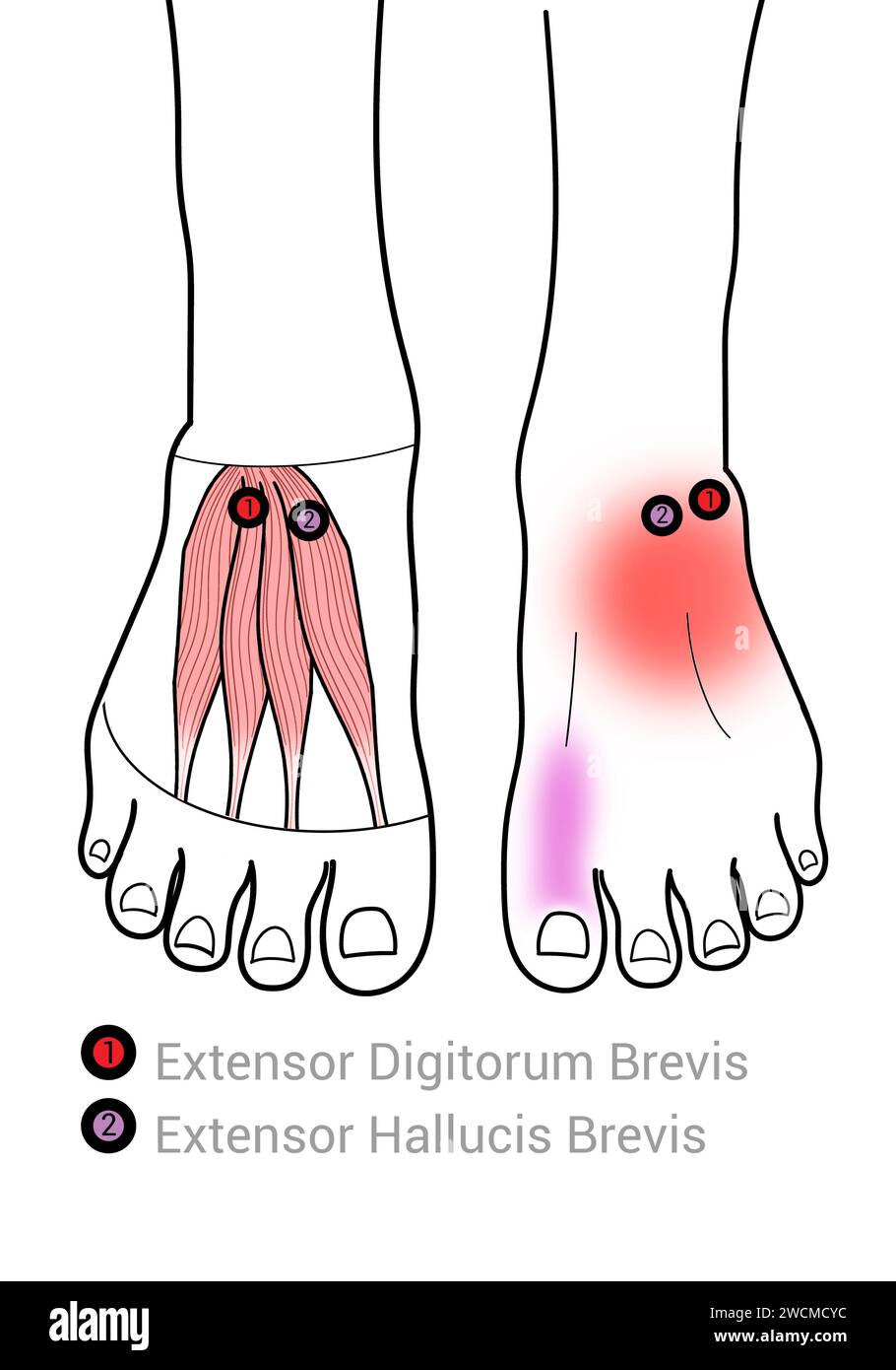 Extensor digitorum Brevis: Myofasziale Triggerpunkte und assoziierte Schmerzorte Stockfoto