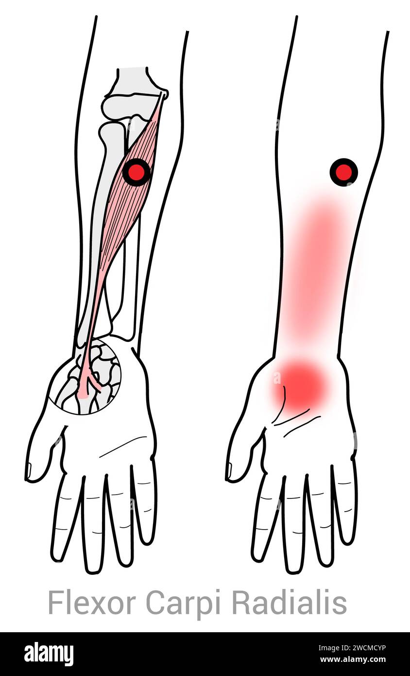 Flexor Carpi radialis: Myofasziale Triggerpunkte und assoziierte Schmerzstellen Stockfoto