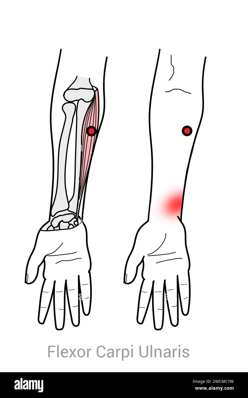 Flexor Carpi ulnaris: Myofasziale Triggerpunkte und assoziierte Schmerzorte Stockfoto