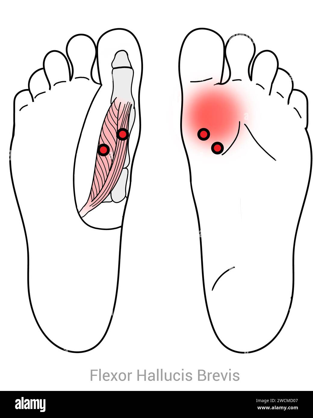 Flexor hallucis Brevis: Myofasziale Triggerpunkte und assoziierte Schmerzorte Stockfoto