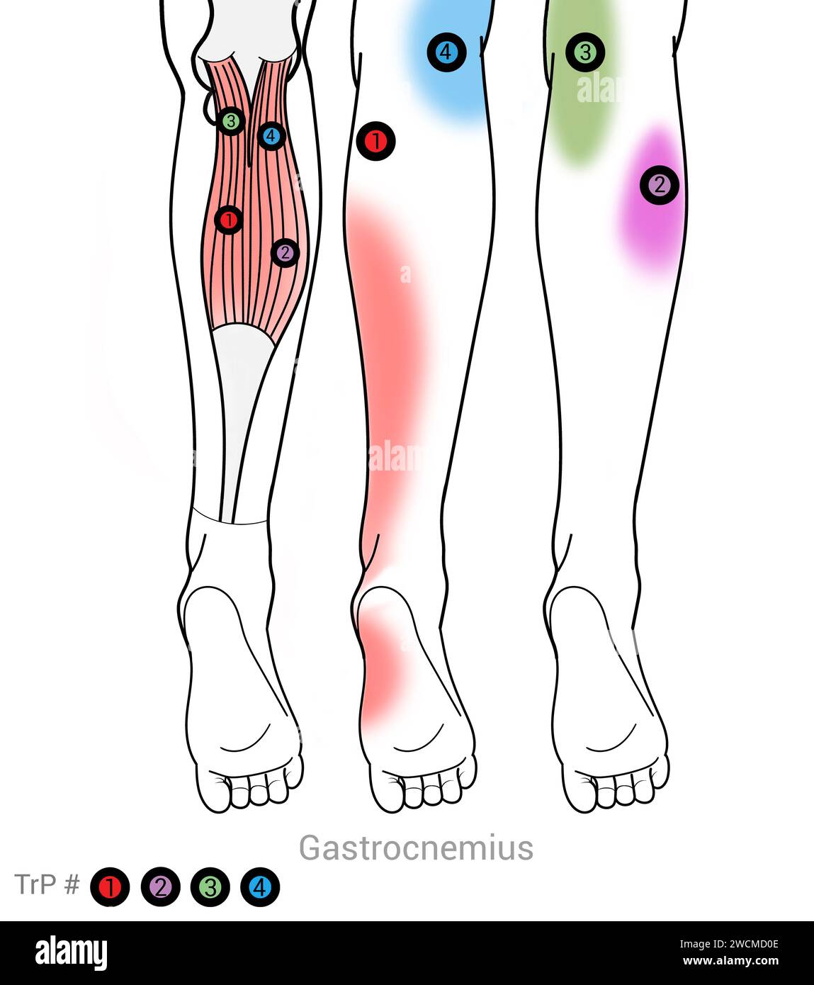 Gastrocnemius: Myofasziale Triggerpunkte und damit verbundene Schmerzorte Stockfoto