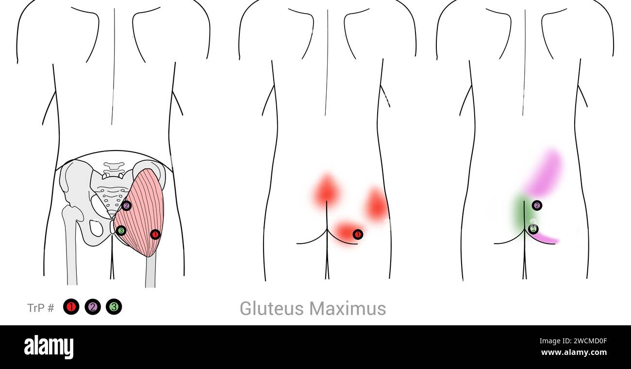 Gluteus Maximus: Myofasziale Triggerpunkte und damit verbundene Schmerzorte Stockfoto