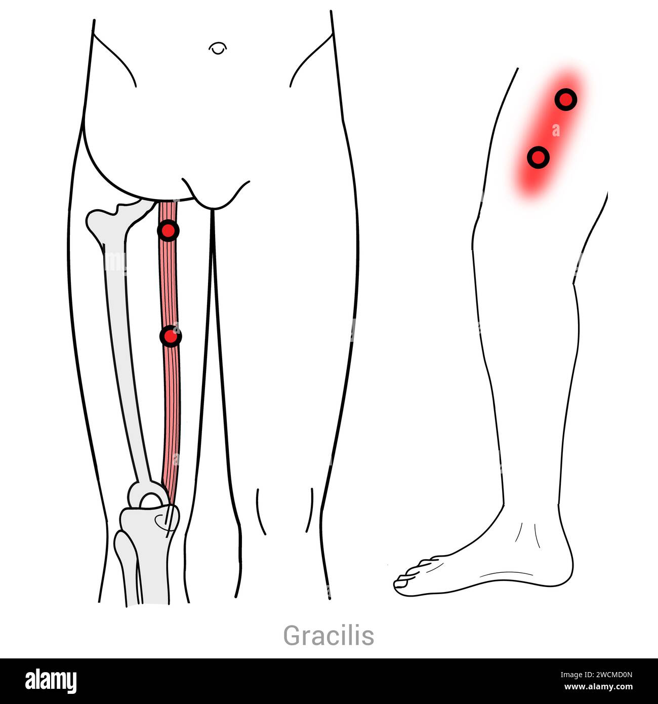 Gracilis: Myofasziale Triggerpunkte und assoziierte Schmerzorte Stockfoto