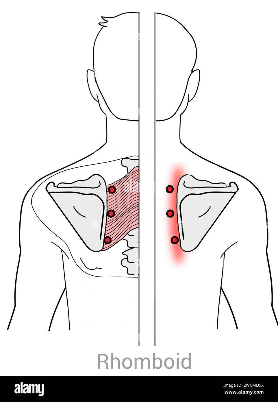 Rhomboid: Myofasziale Triggerpunkte und damit verbundene Schmerzstellen Stockfoto