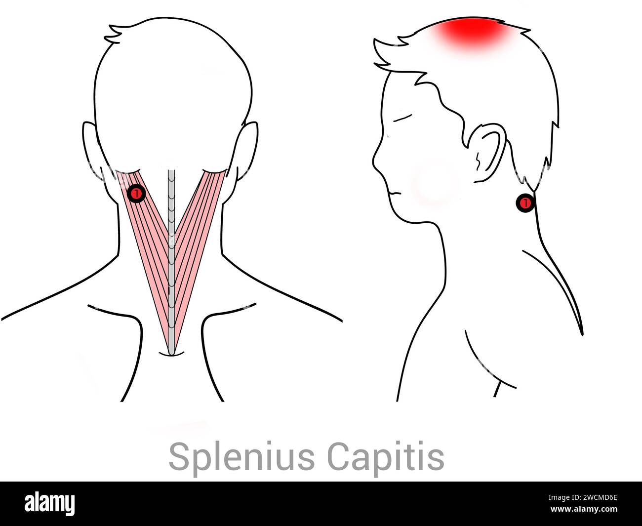 Splenius capitis: Myofasziale Triggerpunkte und damit verbundene Schmerzorte Stockfoto