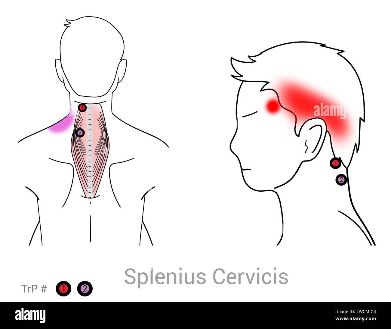 Splenius cervicis: Myofasziale Triggerpunkte und assoziierte Schmerzorte Stockfoto