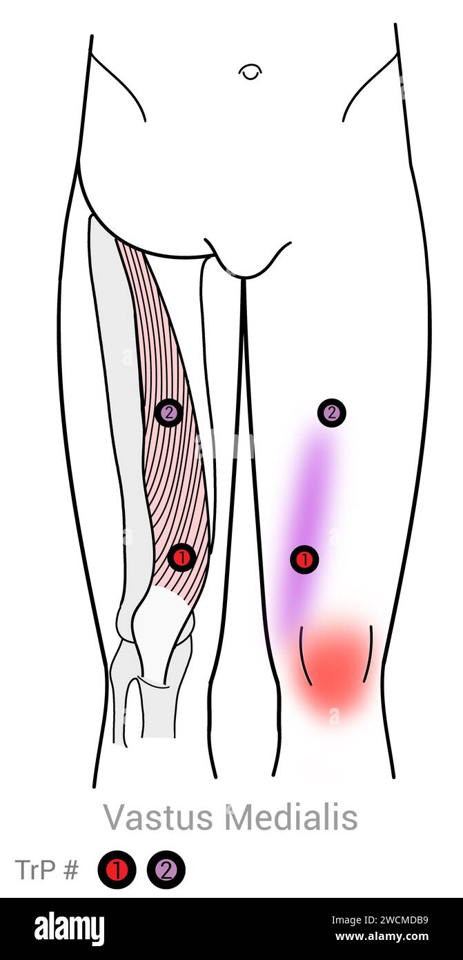 Vastus medialis: Myofasziale Triggerpunkte und assoziierte Schmerzorte Stockfoto