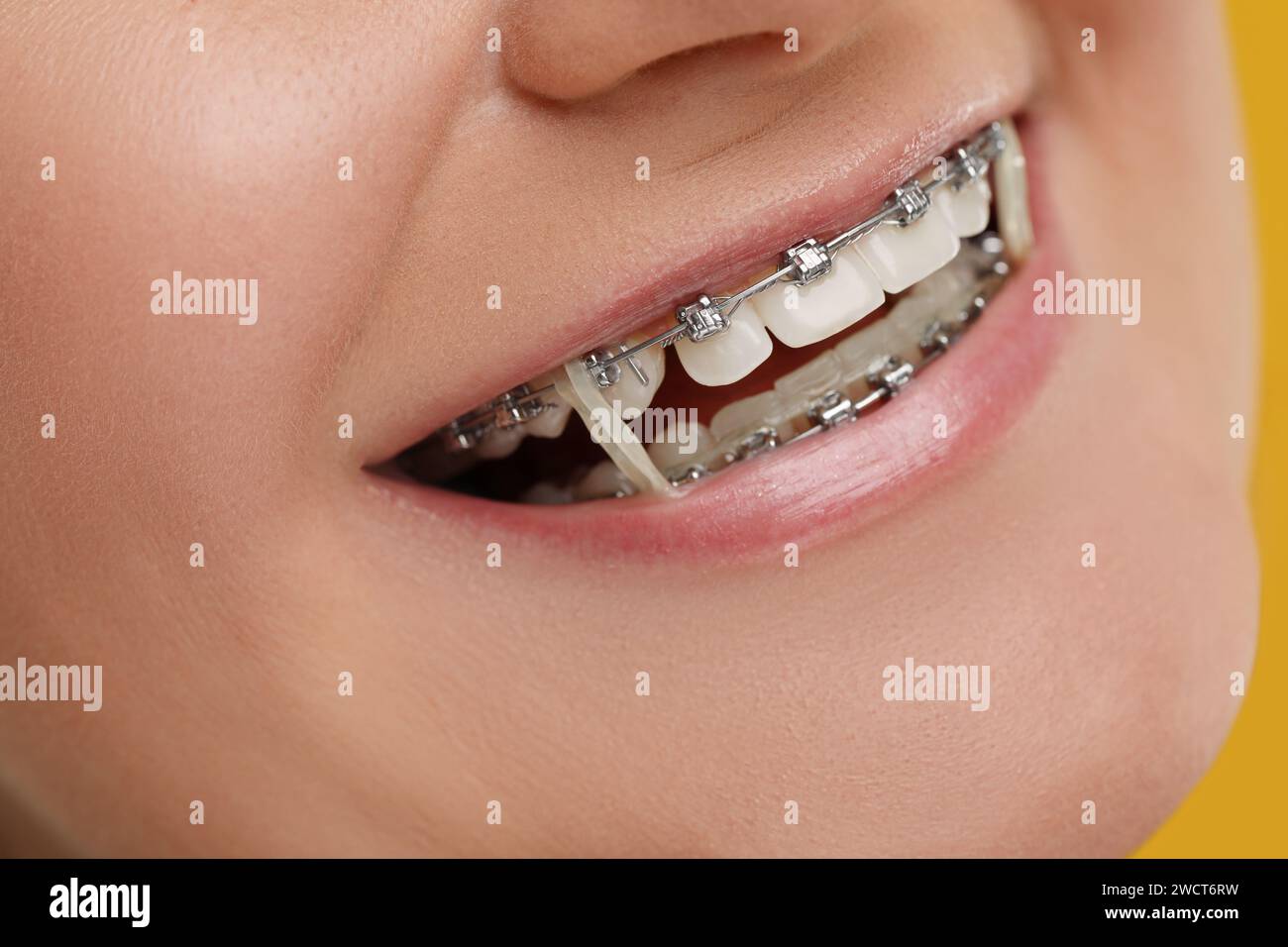 Lächelnde Frau mit Zahnspangen und kieferorthopädischen Gummibändern, Nahaufnahme Stockfoto