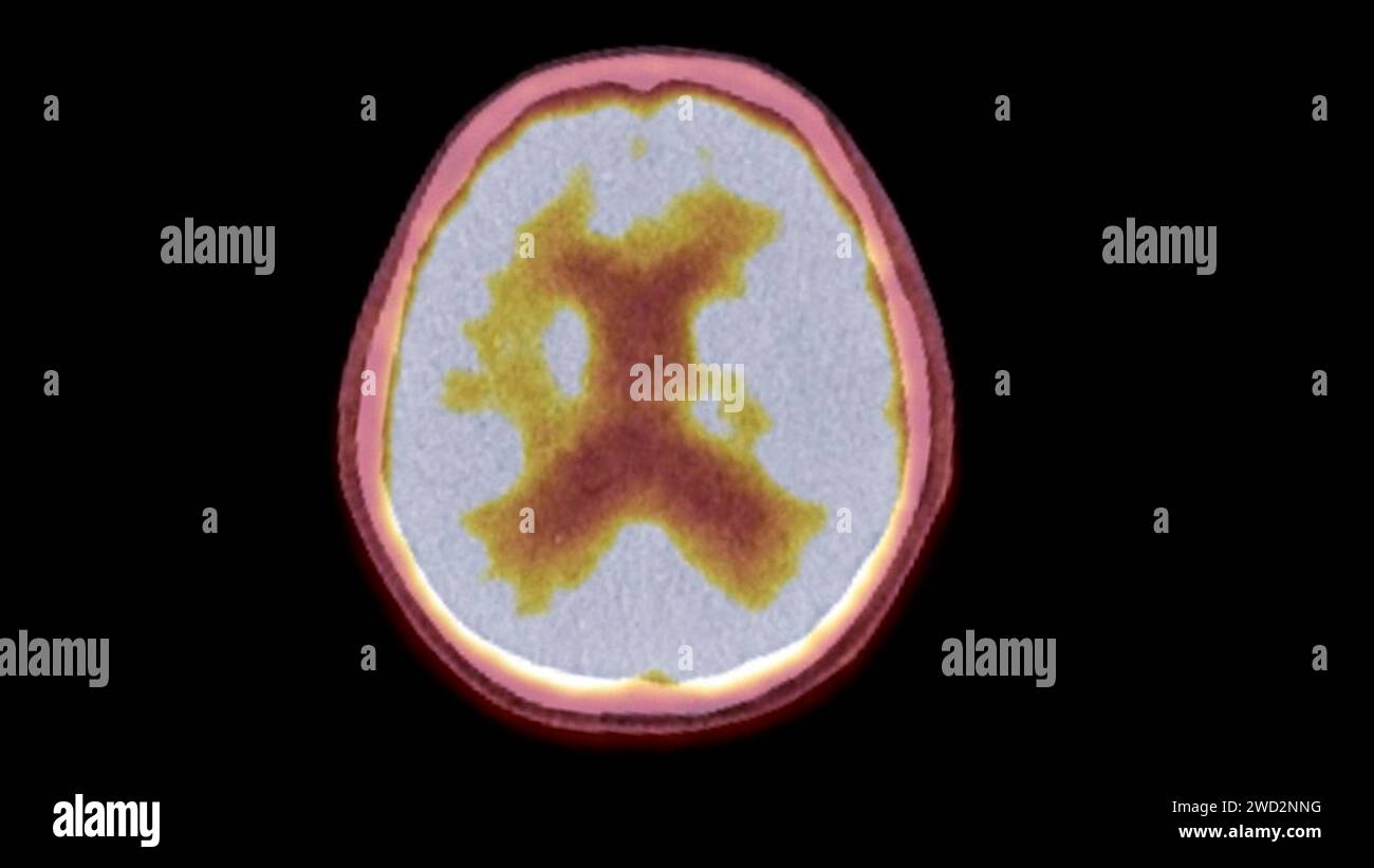 Ein PET-CT-Scan-Bild ist eine diagnostische Visualisierung, die Positronen-Emissions-Tomographie (PET) und Computertomographie (CT) kombiniert, um eine bessere Erkennung zu ermöglichen Stockfoto