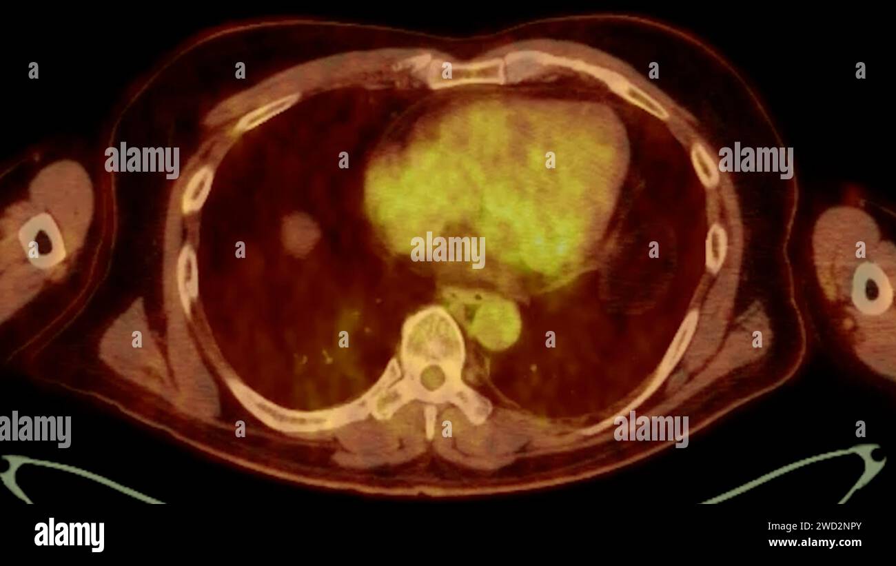 Ein PET-CT-Scan-Bild ist eine diagnostische Visualisierung, die Positronen-Emissions-Tomographie (PET) und Computertomographie (CT) kombiniert, um eine bessere Erkennung zu ermöglichen Stockfoto