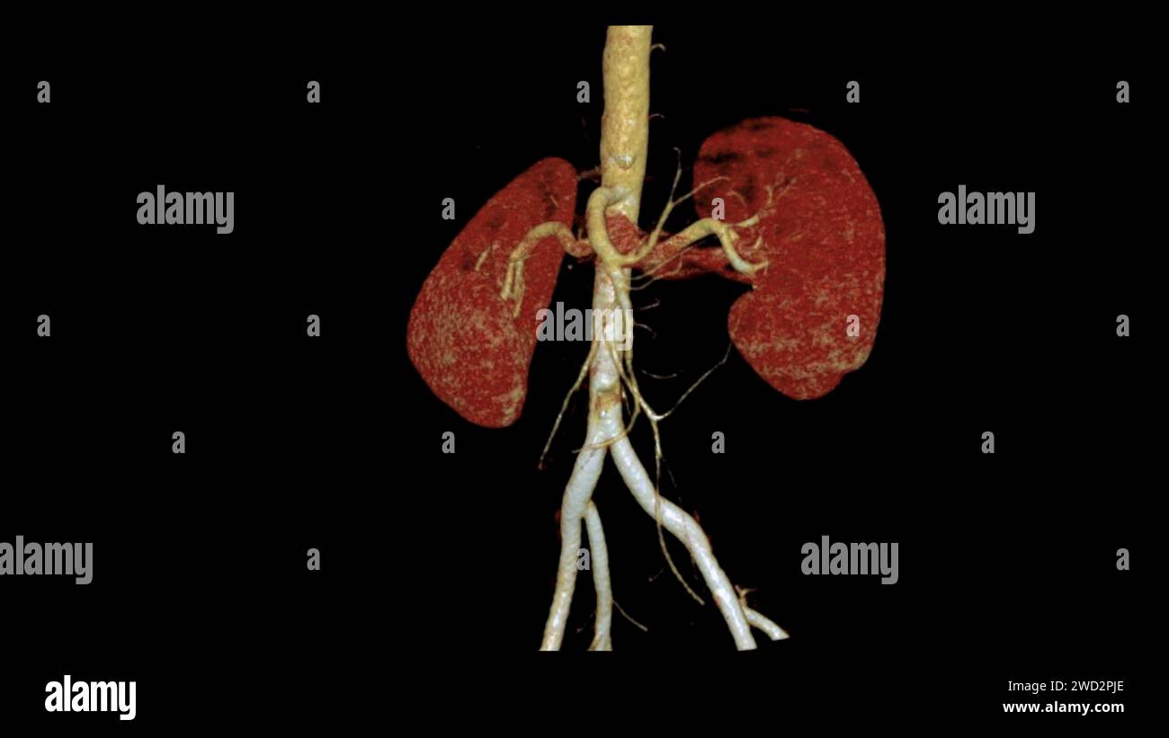 CTA renale Arteria 3D ist ein medizinisches Bildgebungsverfahren mit CT-Scans zur Untersuchung der Nierenarterien. Es liefert detaillierte Bilder der Blutgefäße Stockfoto