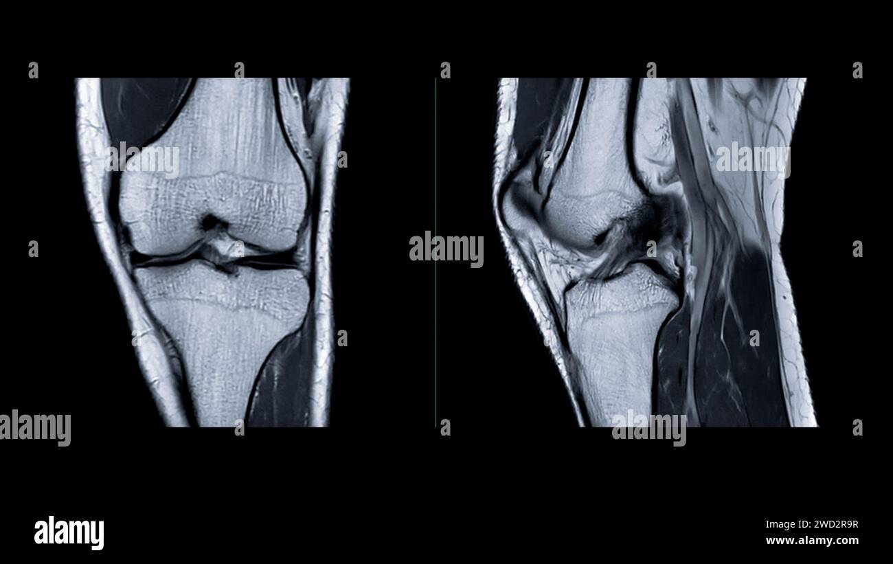 magnetresonanztomographie-oder-mrt-des-kniegelenks-diese