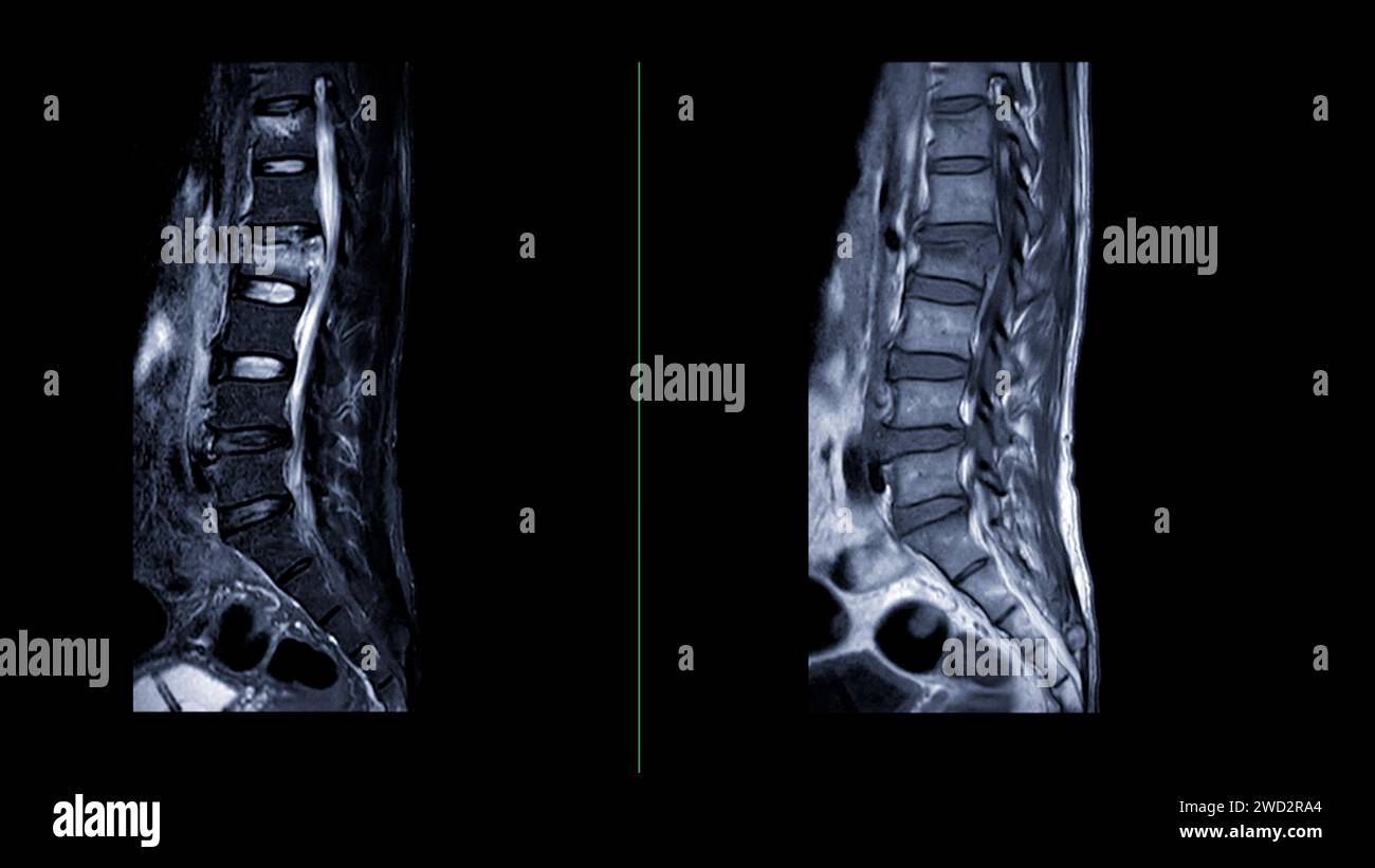 MRT L-S-Wirbelsäule oder Lendenwirbelsäule Sagittalansicht zur Diagnose Rückenmarkkompression. Stockfoto