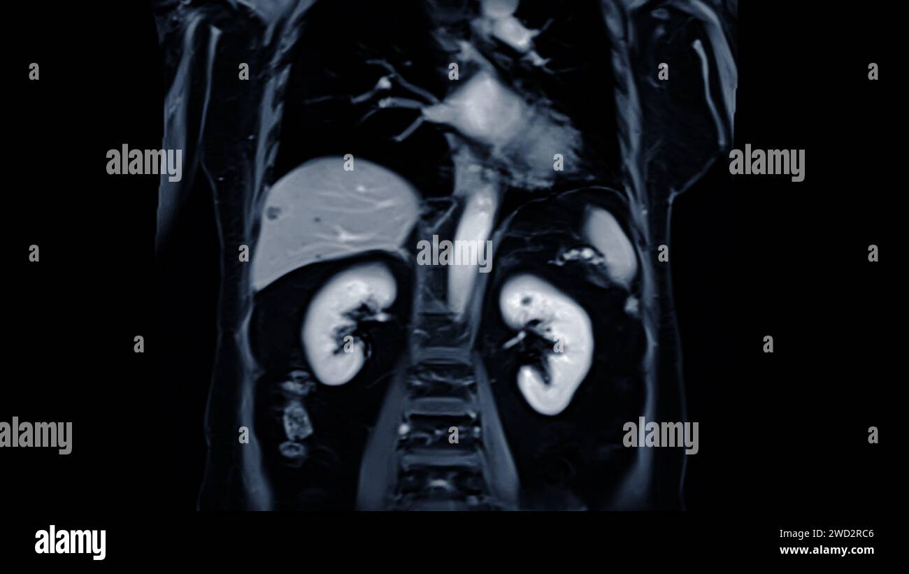 Die MRT der koronalen Ansicht des Oberbauches ist eine nicht-invasive Bildgebung, die detaillierte Darstellung von Organen wie Leber, Bauchspeicheldrüse und Nieren ermöglicht. Stockfoto