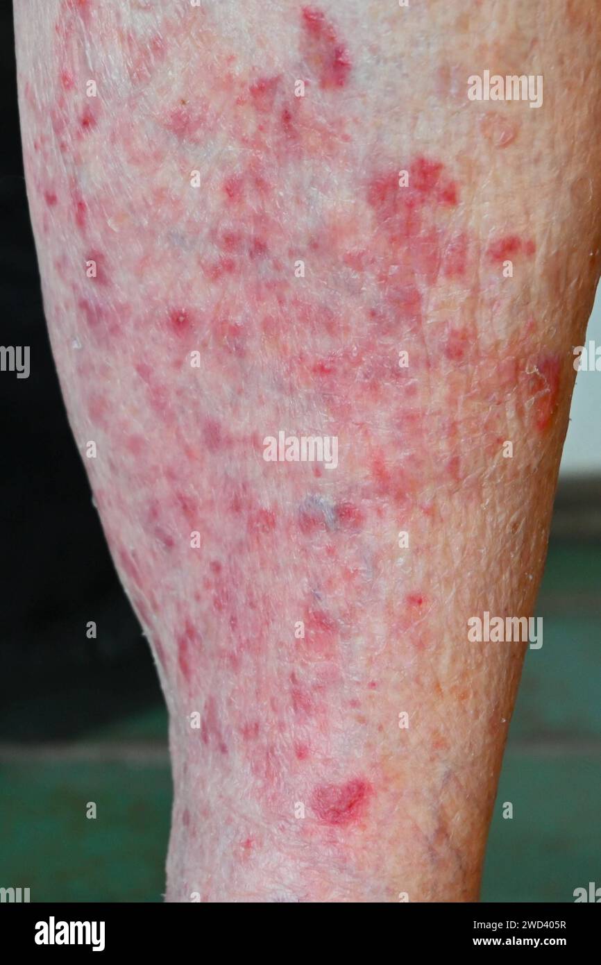 Untersuchung in der Dermatologie bzw beim Hautarzt nach einer