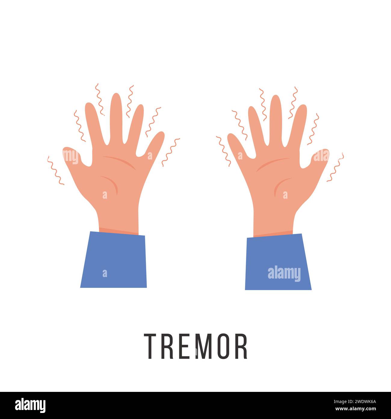 Hände mit Tremor-Symptom. Morbus Parkinson. Zitternde oder zitternde Arme. Physiologische Belastungssymptome. Psychische Störungen, Panik, Angst. Vektorillust Stock Vektor