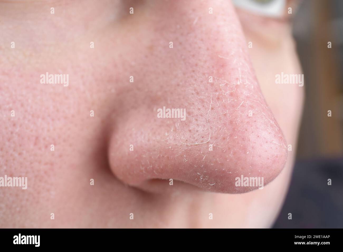 Frau mit trockener Haut auf der Nase, Nahaufnahme Stockfoto