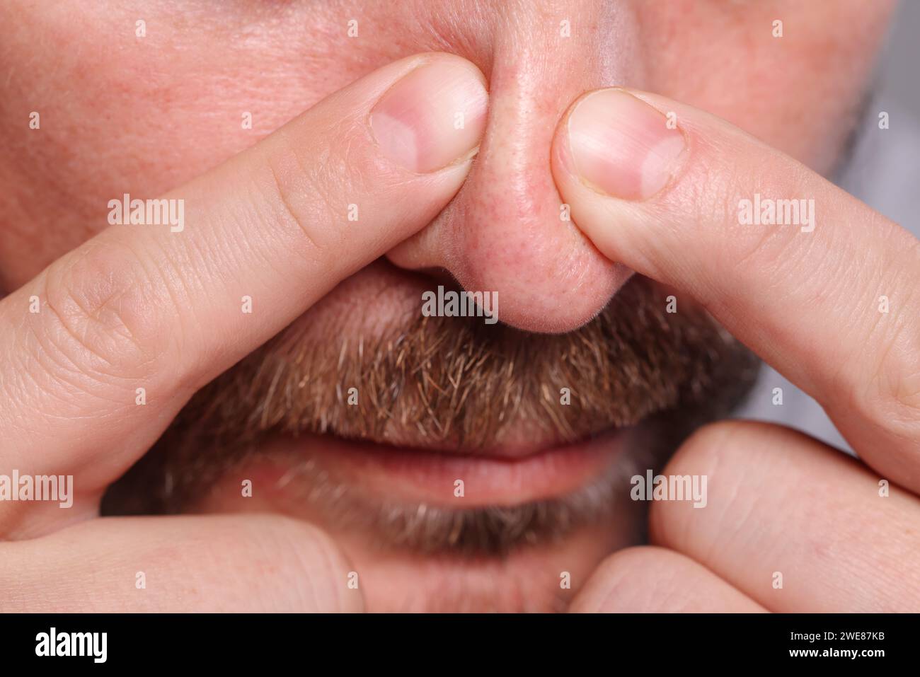 Mann, der Pickel auf seine Nase wirft, Nahaufnahme Stockfoto