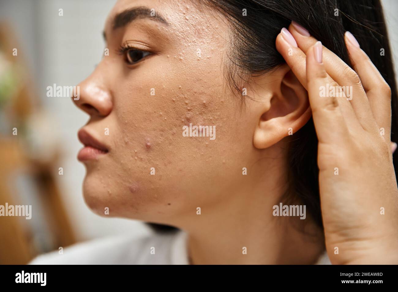 Hautpflegethemen Konzept, Nahaufnahme einer jungen asiatischen Frau mit brünetten Haaren und Akne im Gesicht Stockfoto