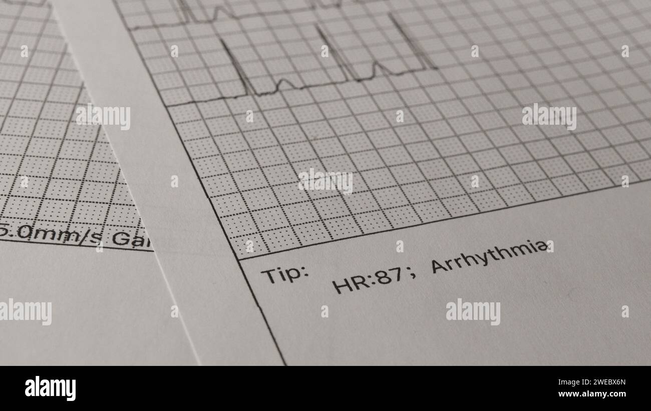 Faxe oder Fotokopien von EKG-Berichten : Arrhythmie und Herzfrequenz Stockfoto