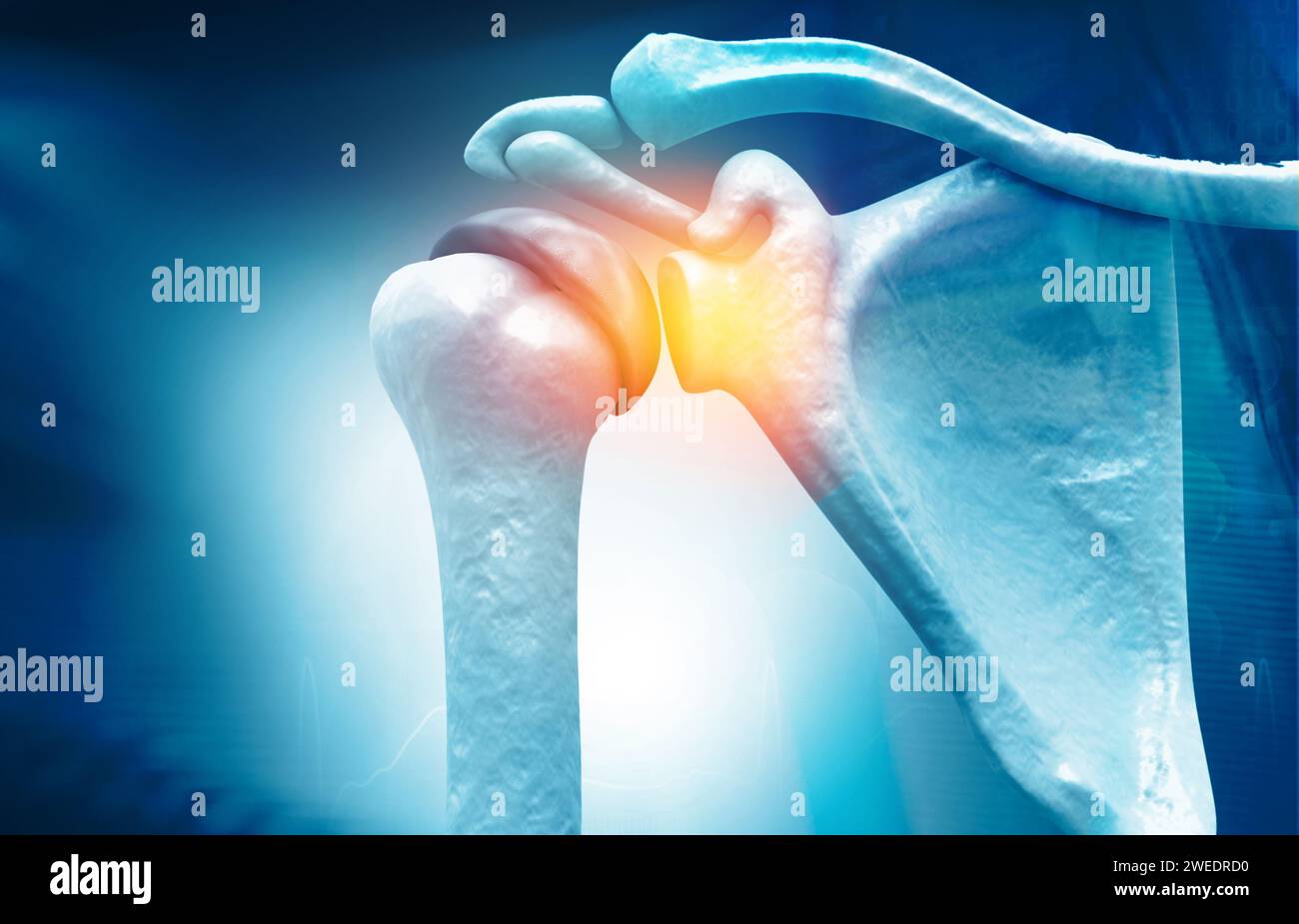 Anatomie der Schulter, Riss der Rotatorenmanschette, Schulterschmerzen. 3D-Abbildung Stockfoto