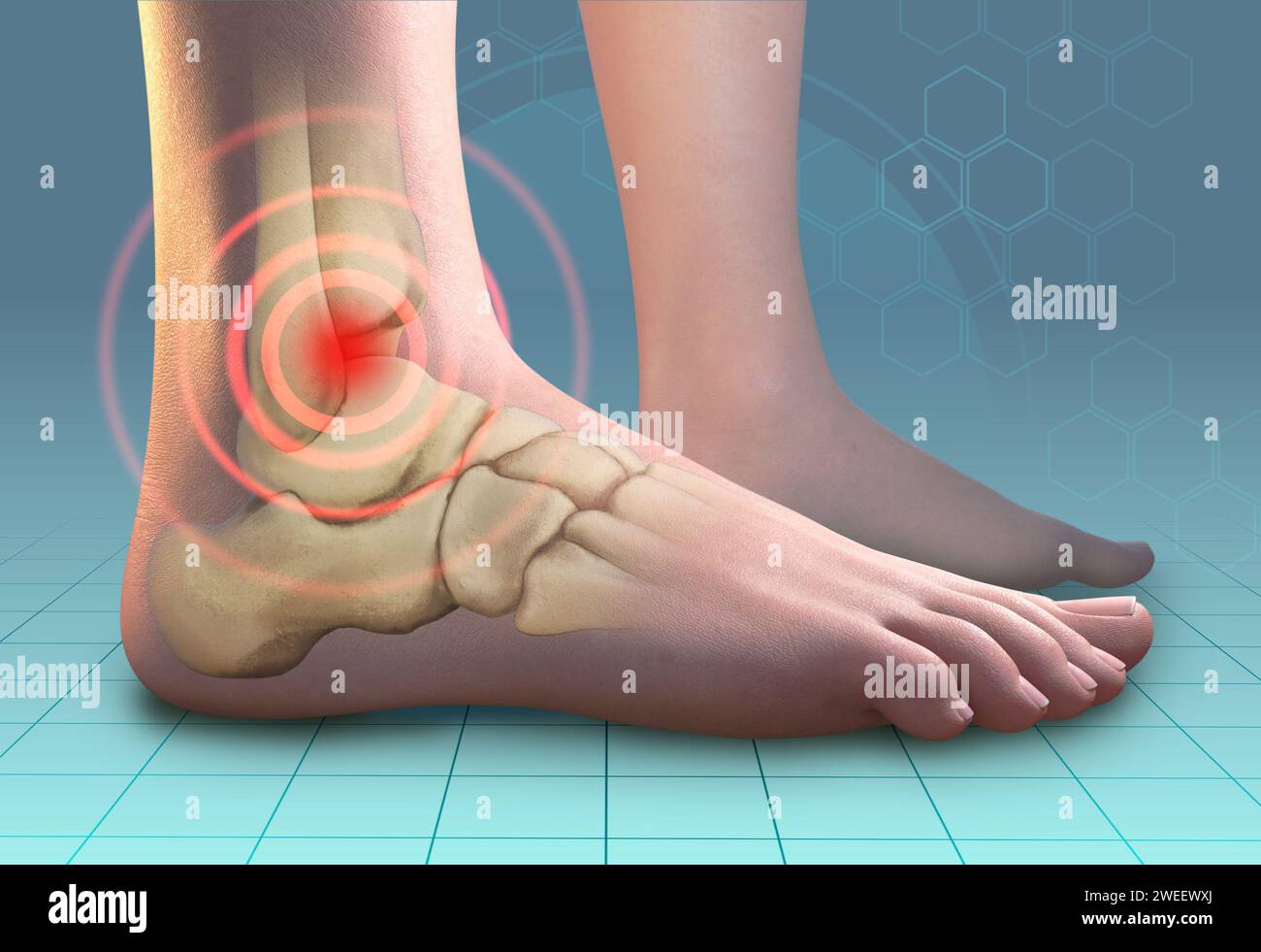 Knöchelschmerzen, die durch Traumata oder andere gesundheitliche Probleme verursacht werden. Digitale Illustration, 3D-Rendering. Stockfoto