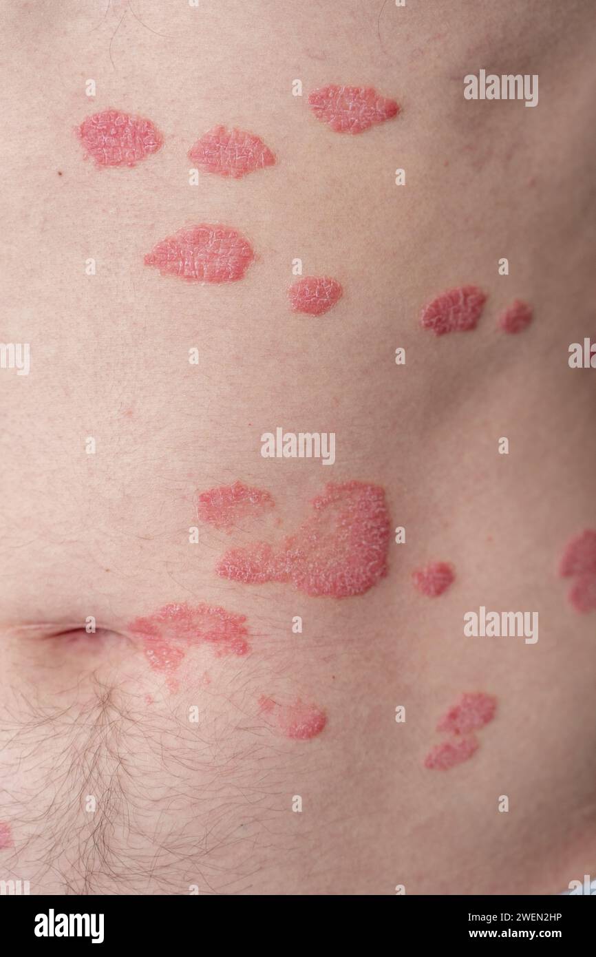 Psoriasis vulgaris, Hautflecken sind in der Regel rot, juckend und schuppig. Stockfoto