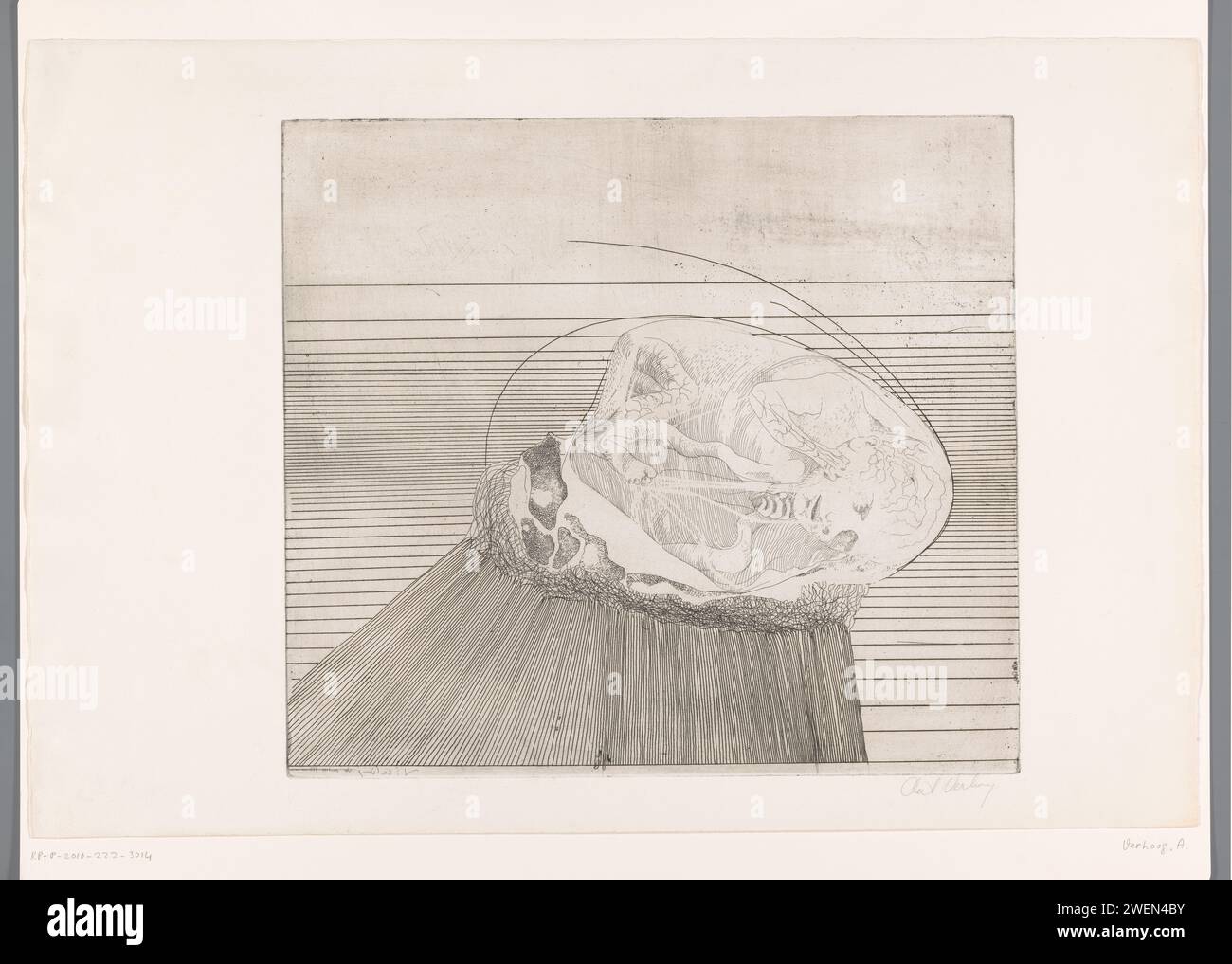 Embryo, AAT erhöht, 1967 Druck Embryo vor dem Hintergrund überwiegend horizontaler Linien. Papierätzung Stockfoto