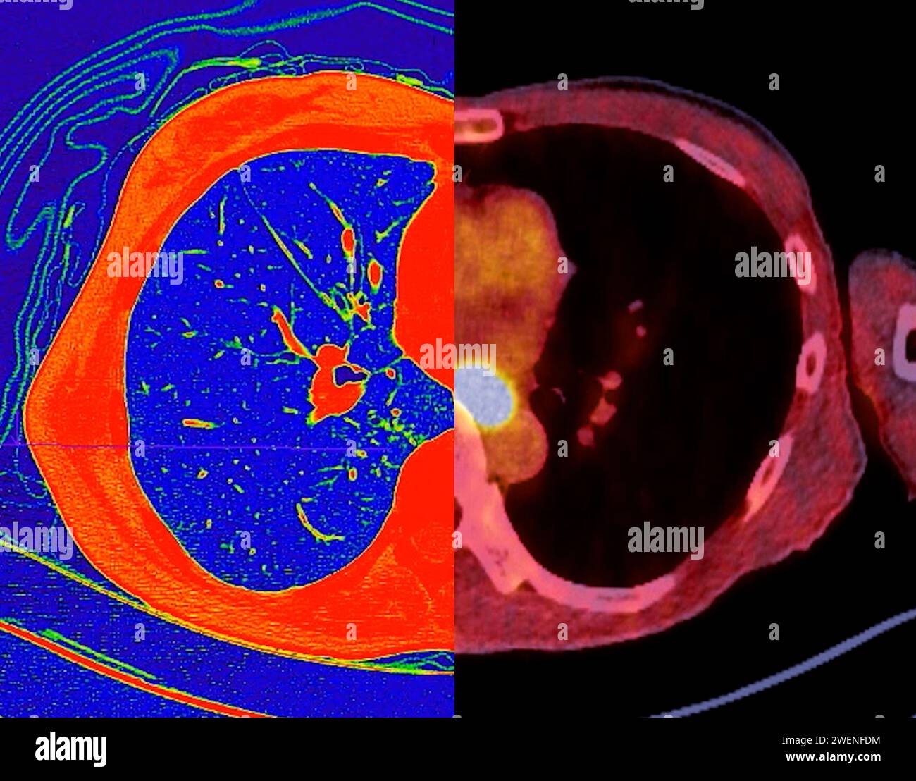 CT-Scan der Thoraxansicht im Farbmodus für diagnostische Lungenembolie (PE), Lungenkrebs und covid-19. Stockfoto