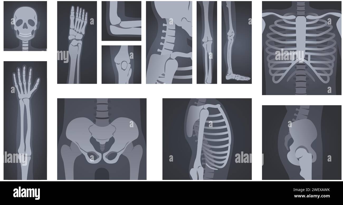 Röntgenaufnahmen. Die menschliche Körperradiologie von Kopf-Schädel, Handknochen, Wirbelsäule und Rippenkäfig-Vektor-Illustration-Set Stock Vektor