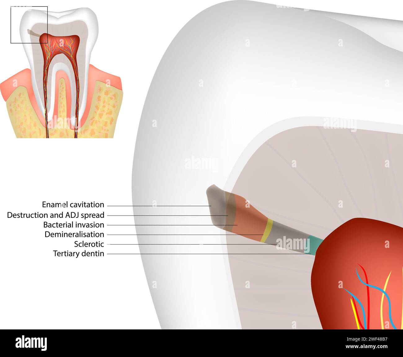 Histopathologie der Kariesbildung in Emaille und Dentin. Der Zahnschmelz-Dentinpulpkomplex. Diagramm. Tertiäres Dentin Stock Vektor