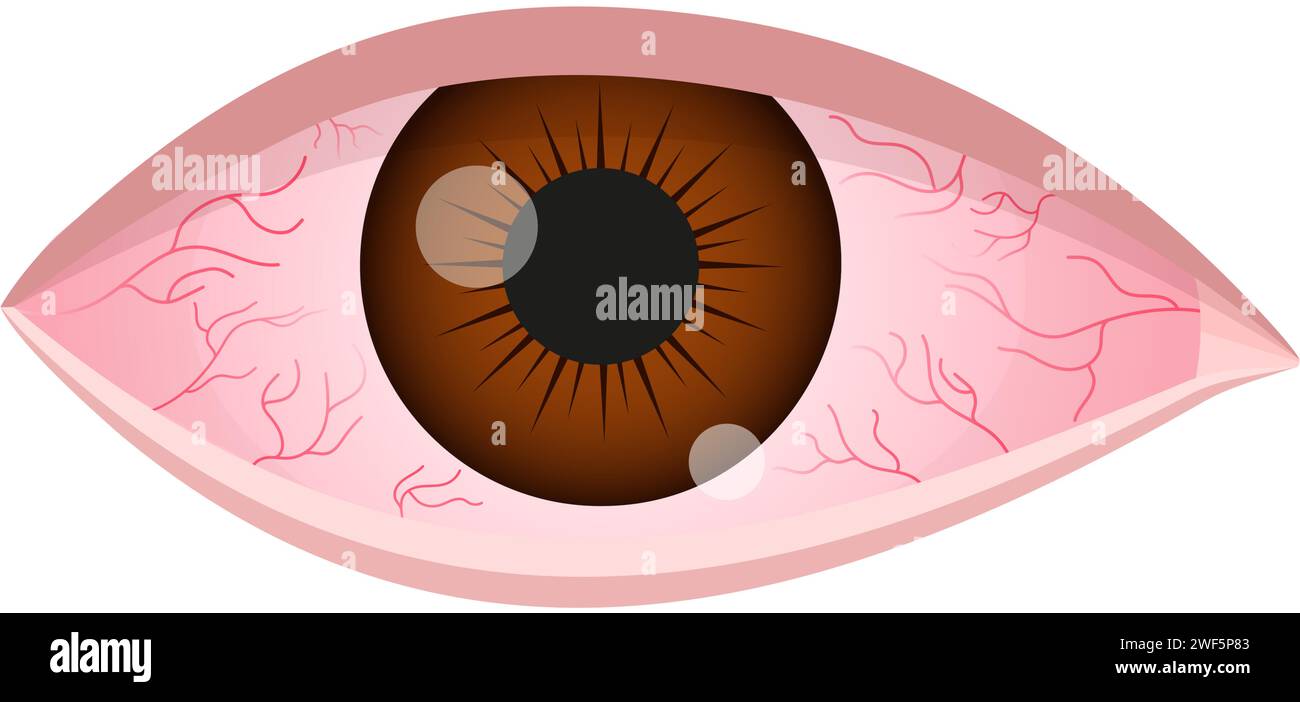 Trockenes Auge-Syndrom. Entzündeter blutunterlaufener Augapfel mit Schwellung, Reizung und roter Bindehaut. Symptome einer Infektion, Allergie, Keratitis, Blepharitis, Konjunktivitis, Uveitis. Vektor-Zeichentrick-Illustration Stock Vektor
