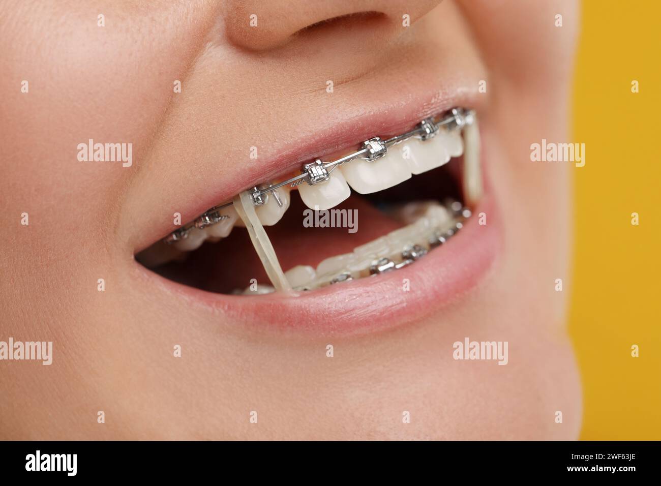 Lächelnde Frau mit Zahnspangen und kieferorthopädischen Gummibändern auf orangem Hintergrund, Nahaufnahme Stockfoto