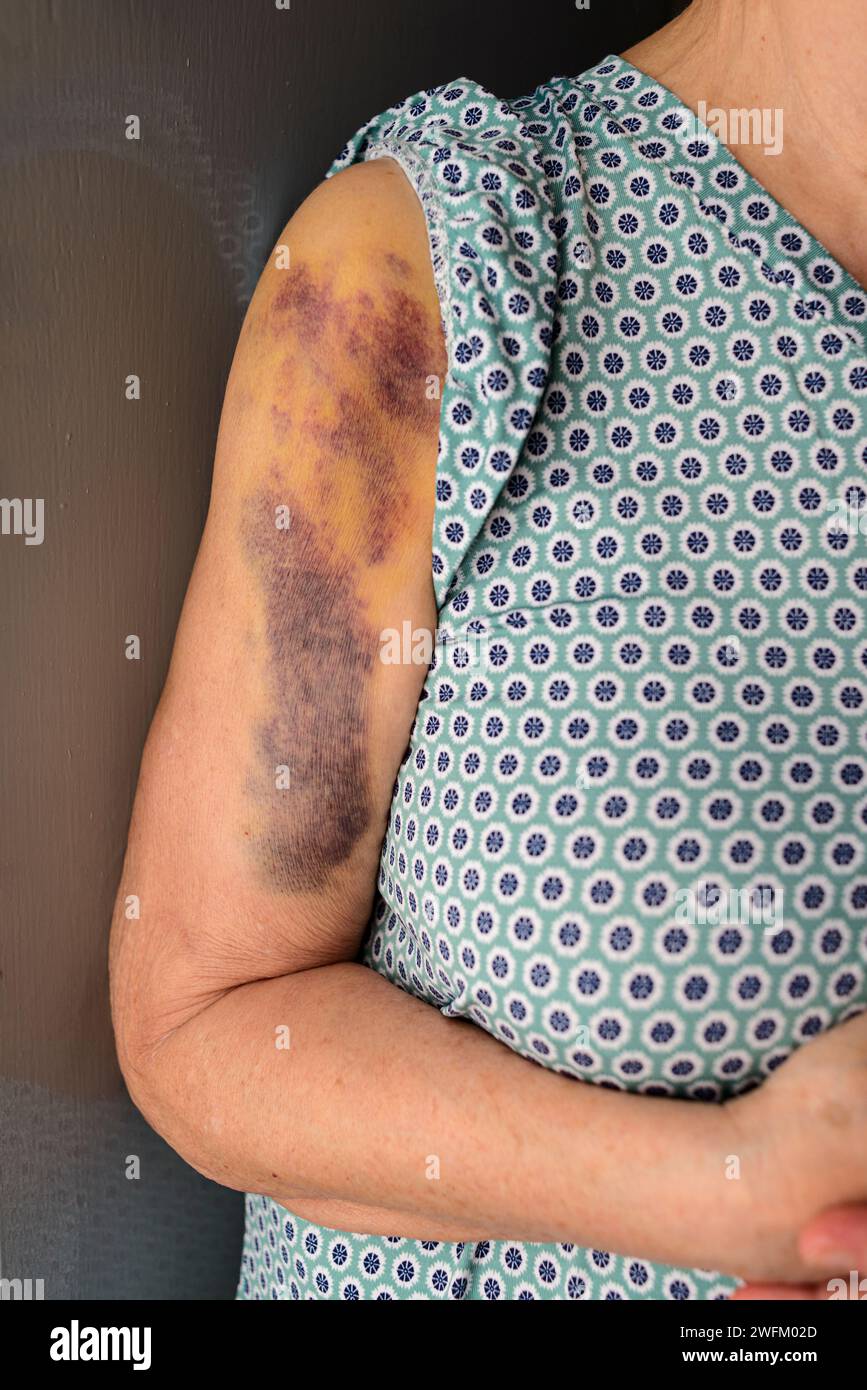 Hämatom am Arm einer älteren Frau durch Stürze. Ältere Menschen neigen zu Verletzungen durch Stürze. Stockfoto