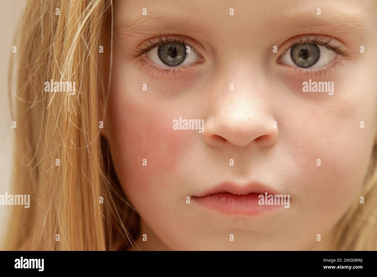 Rötung der Wangen des Kindes durch Ekzem, trockene Haut oder Allergie Stockfoto
