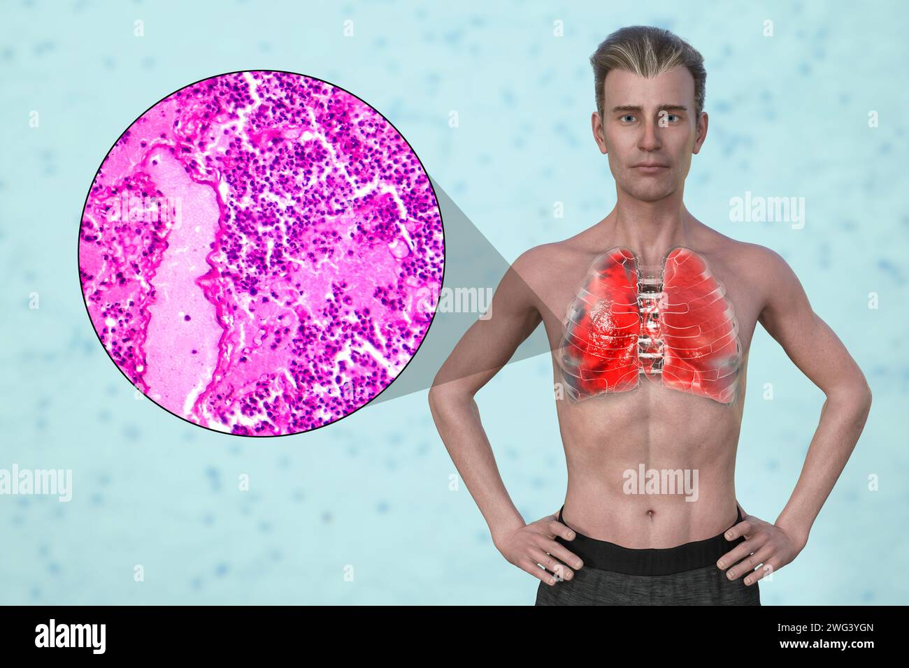 Mann mit Lungenentzündung, Illustration Stockfoto