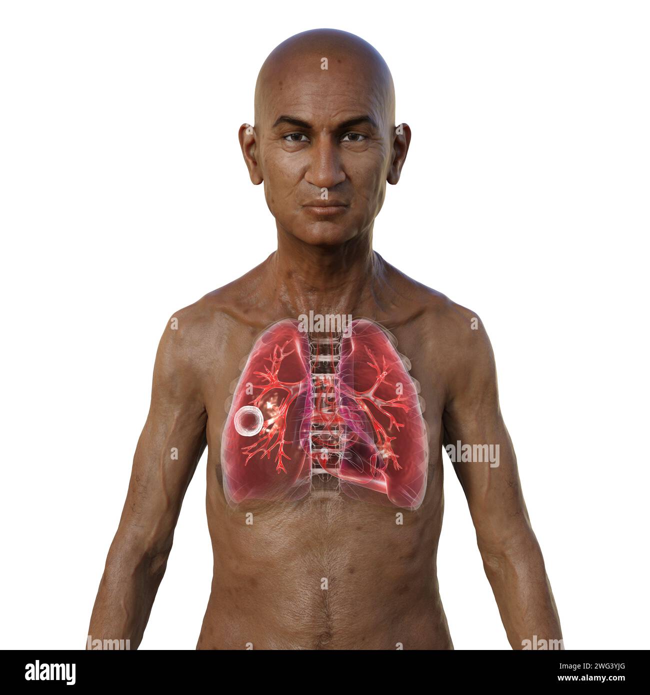 Mann mit Lungen von kavernöser Tuberkulose, Illustration Stockfoto