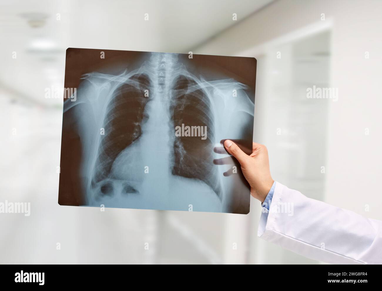Die Hand des Mannes hält eine Lungenradiographie im Krankenhaus Stockfoto