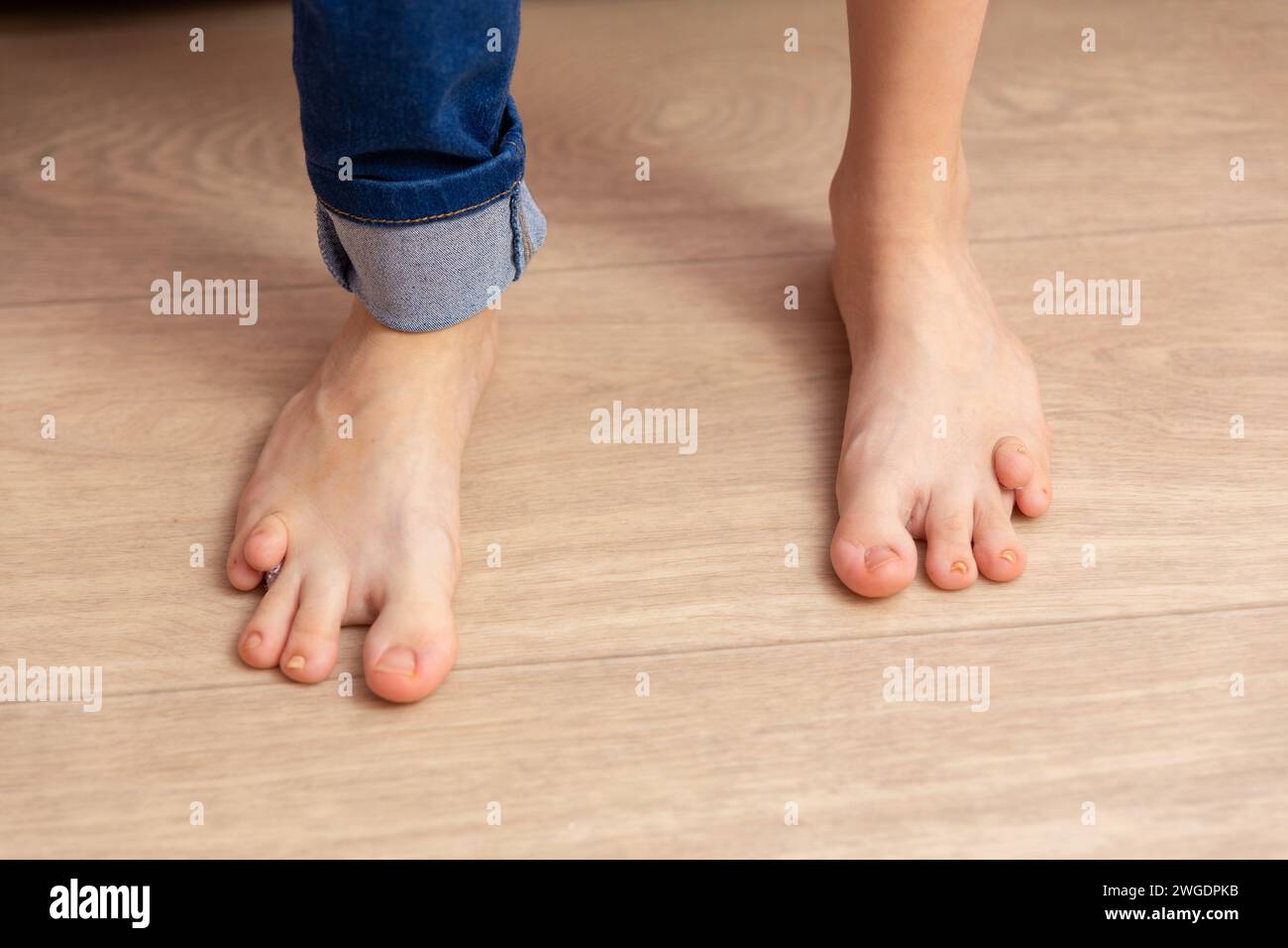 Nahaufnahme der Füße eines dreizehnjährigen Mädchens mit Geburtsfehler. Eine Behinderung verhindert, dass das Mädchen normal läuft und sich entwickelt. Stockfoto