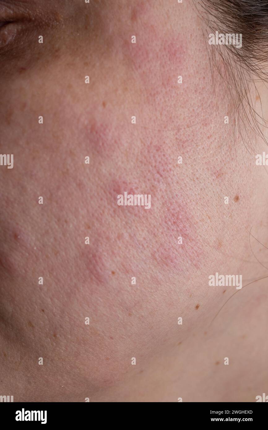 Roter Hautausschlag Ekzem auf einem Gesicht einer Frau wegen Fettleber Krankheit, Nahaufnahme Stockfoto