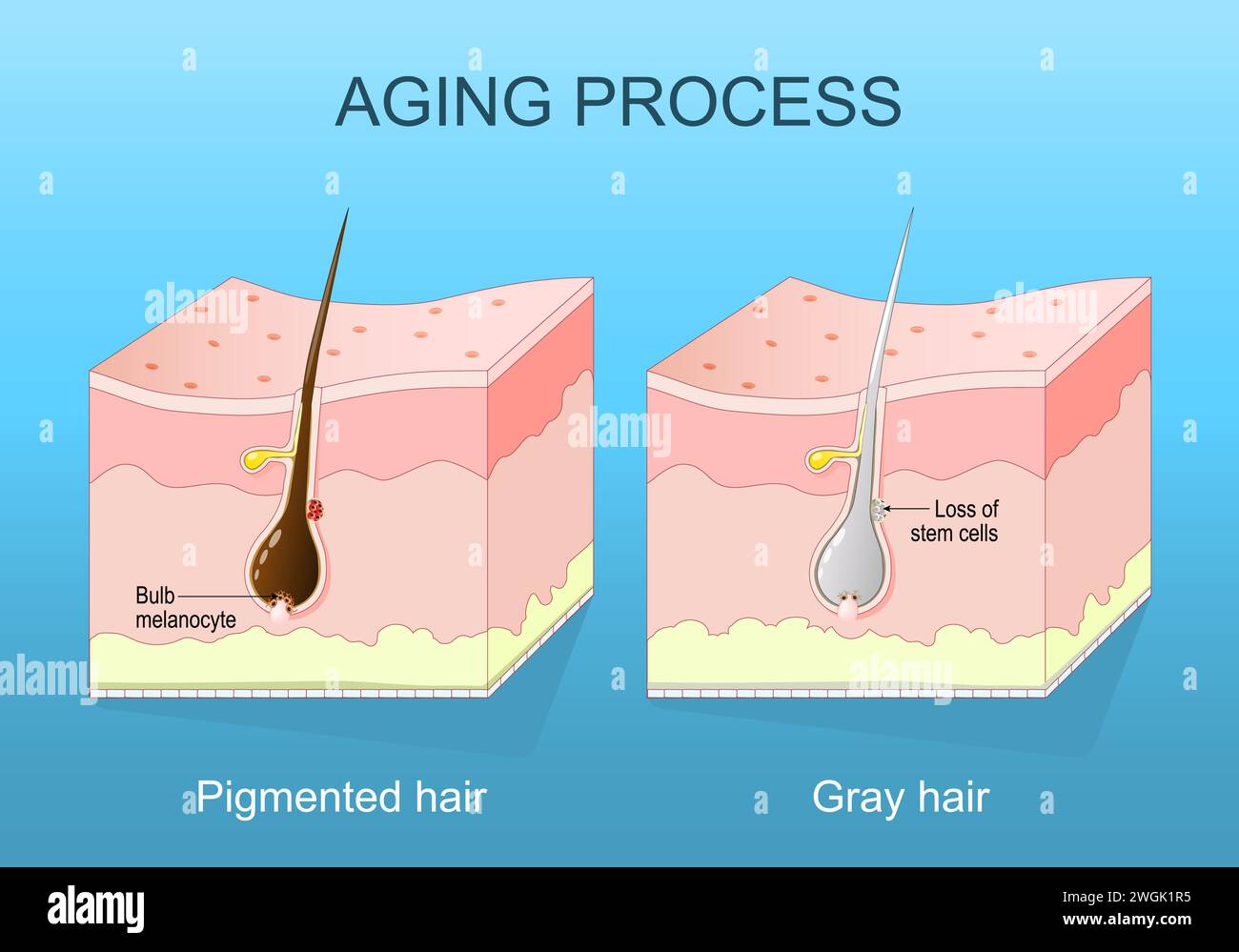 Alterungsprozess. Graues Haar. Melaninmangel und Haarfollikelseneszenz. Querschnitt einer menschlichen Haut. Abbildung des isometrischen flachen Vektors Stock Vektor