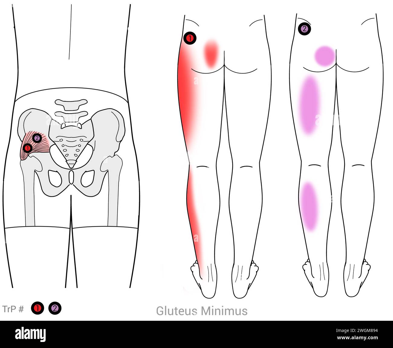 Gluteus minimus: Myofaszialer Triggerpunkt bezieht sich auf Schmerzen in den Hüften, Becken, äußeren Beinen und Gesäß. Stockfoto