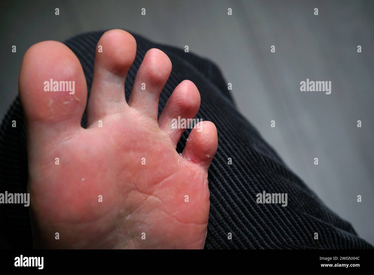 Ahtletes Fußpilz, der auf dem interdigitalen fünften Zeh eines linken weißen Fußes beginnt Stockfoto